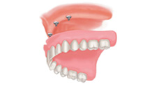 Anchoring Dentures