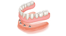 Anchoring Dentures